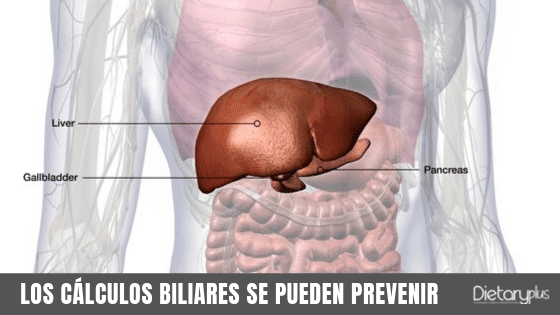 Los cálculos biliares se pueden prevenir